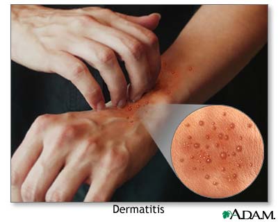 Bagaimana pencegahan dan pengobatan dermatitis