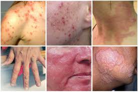 dermatitis